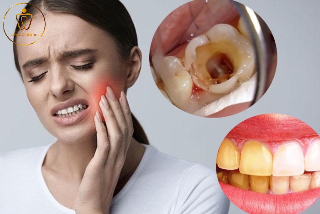 Bọc răng sứ kém chất lượng có thể gây ra nhiều biến chứng khôn lường