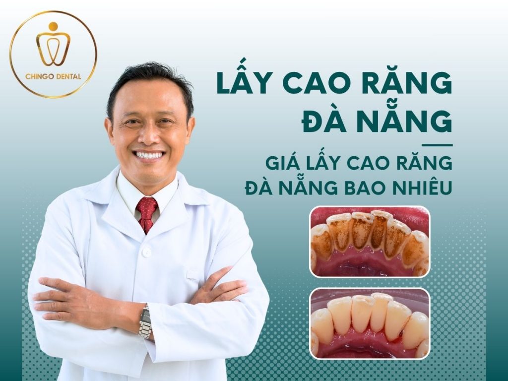 Chingo Dental lay cao rang da nang uy tin