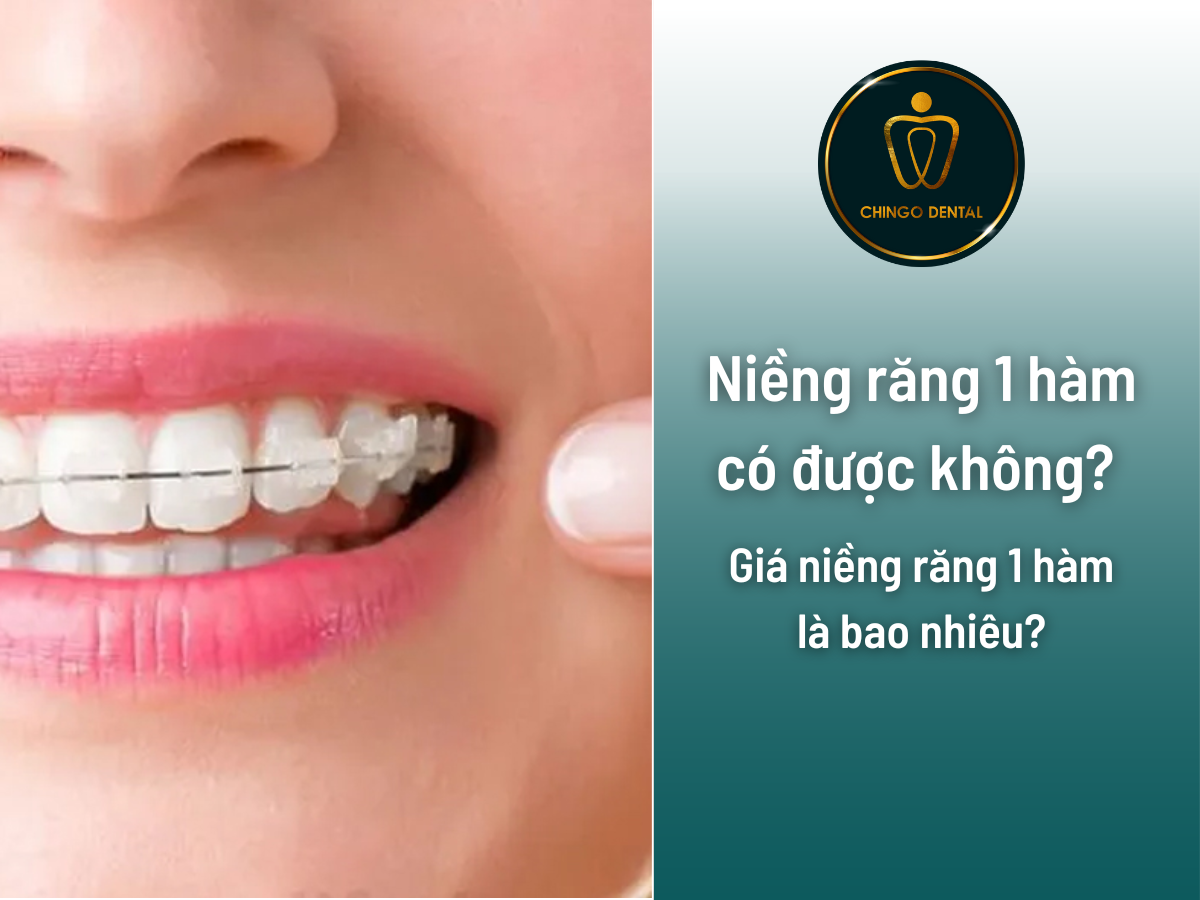 Niềng răng 1 hàm có được không? giá niềng răng 1 hàm là bao nhiêu ...