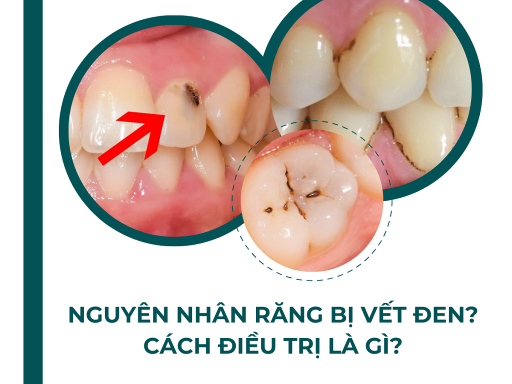 NGUYEN NH N TAI SAO RANG BI VET DEN CACH DIEU TRI LA GI