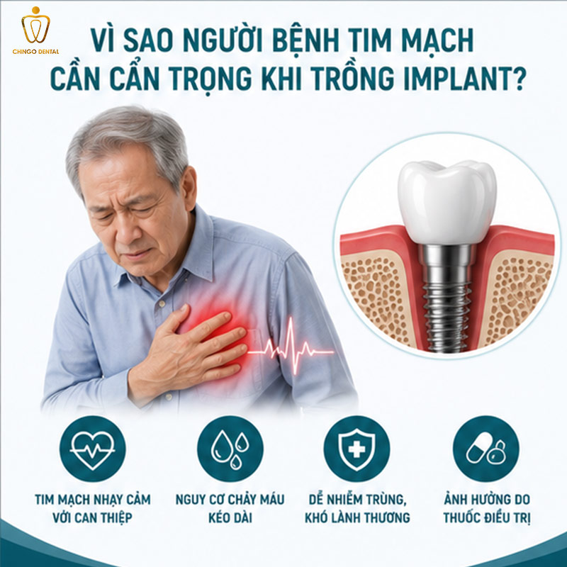 Bị Tim Mạch Có Trồng Răng Implant Được Không? Giải Đáp Từ Chuyên Gia 23 bị tim mạch có trồng răng implant được không