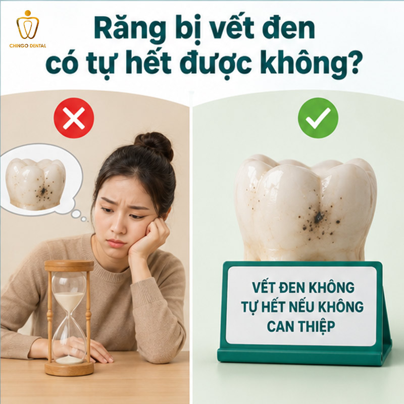 Răng Bị Vết Đen: Nguyên Nhân, Cách Nhận Biết Và Điều Trị Hiệu Quả 3 răng bị mảng bám đen phải làm sao