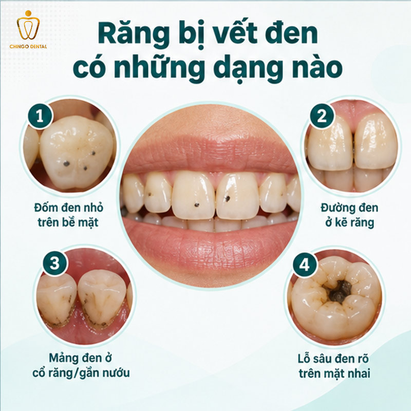 Răng Bị Vết Đen: Nguyên Nhân, Cách Nhận Biết Và Điều Trị Hiệu Quả 1 răng bị vết đen