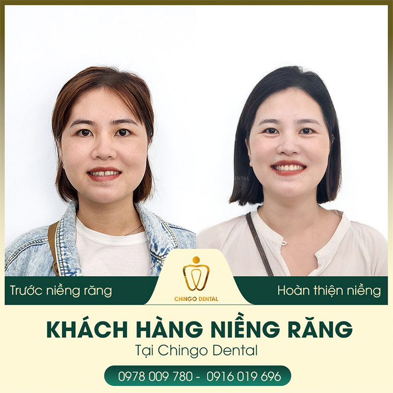40 tuổi có niềng răng được không