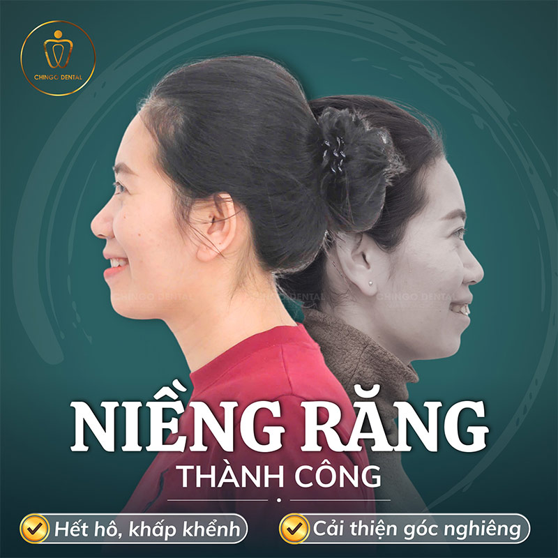 40 tuổi còn niềng răng được không