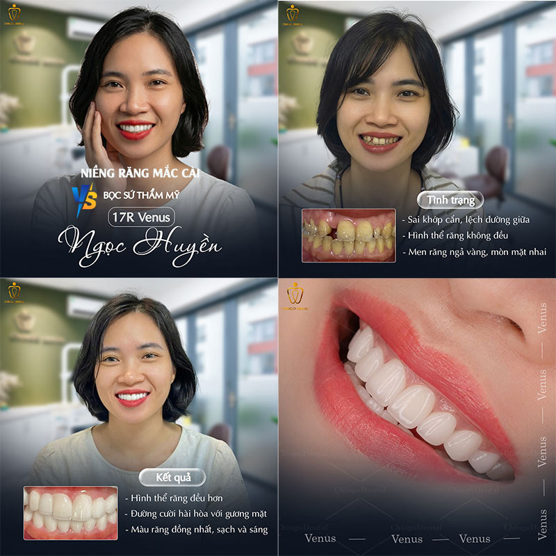 40 tuổi niềng răng có được không