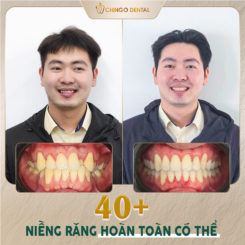 40 tuổi niềng răng được không