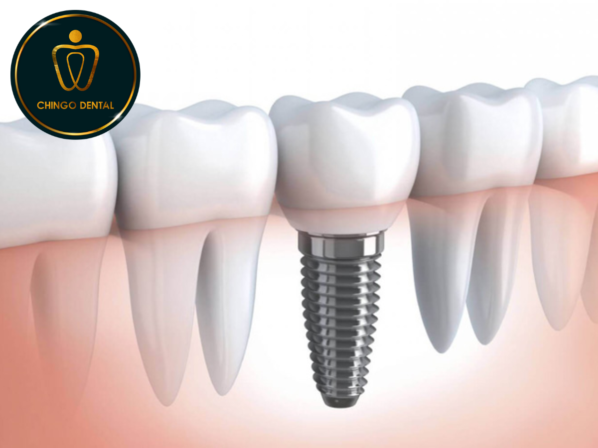 5 LY DO NEN TRONG RANG IMPLANT 4