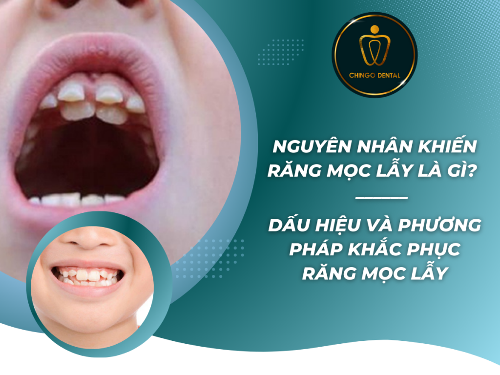 Nguyen nhan khien rang moc lay la gi Dau hieu va phuong phap khac phuc rang moc lay