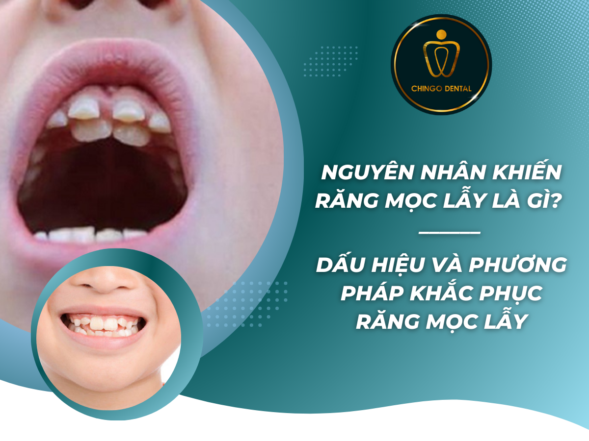 Nguyên nhân khiến răng mọc lẫy là gì Dấu hiệu và phương pháp khắc phục răng mọc lẫy