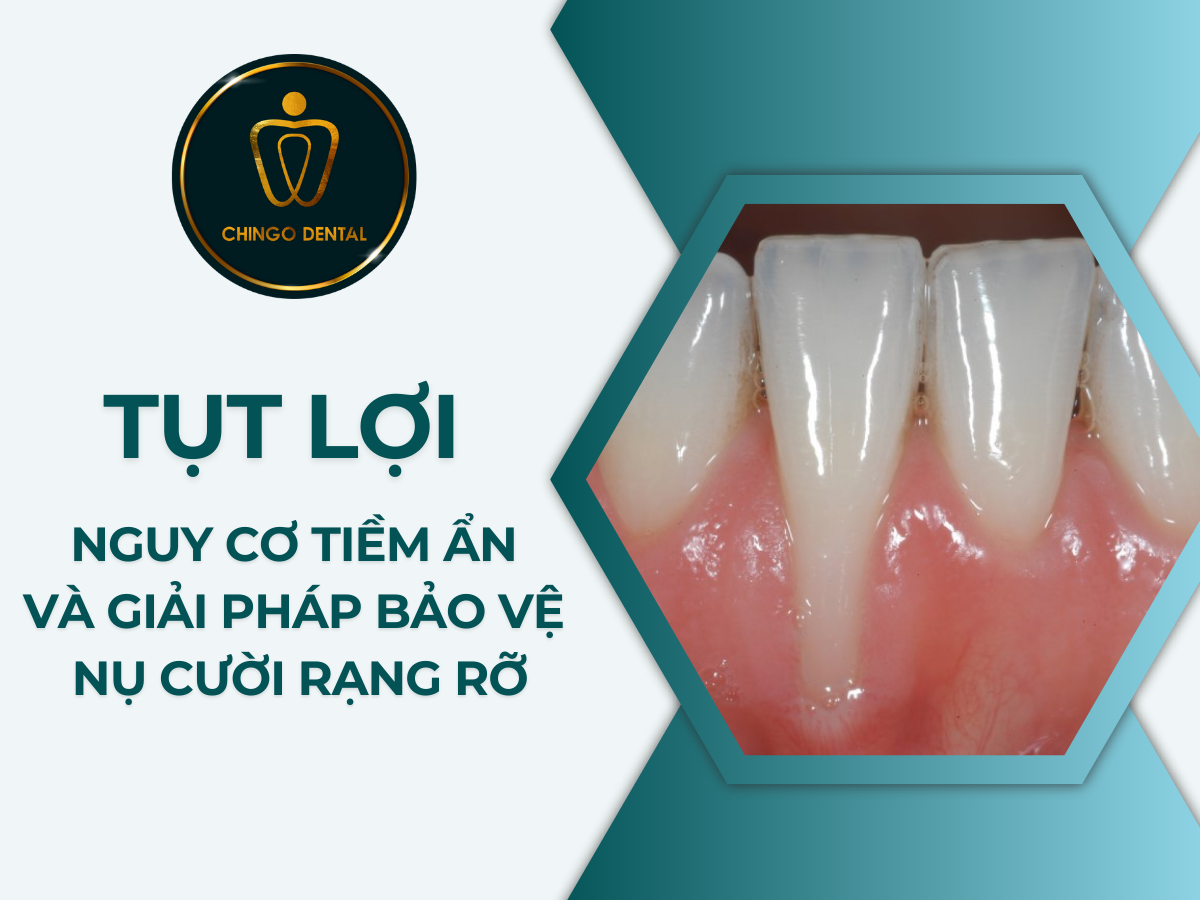 TỤT LỢI - NGUY CƠ TIỀM ẨN VÀ GIẢI PHÁP BẢO VỆ NỤ CƯỜI RẠNG RỠ TỤT LỢI NGUY CƠ TIỀM ẨN VÀ GIẢI PHÁP BẢO VỆ NỤ CƯỜI RẠNG RỠ