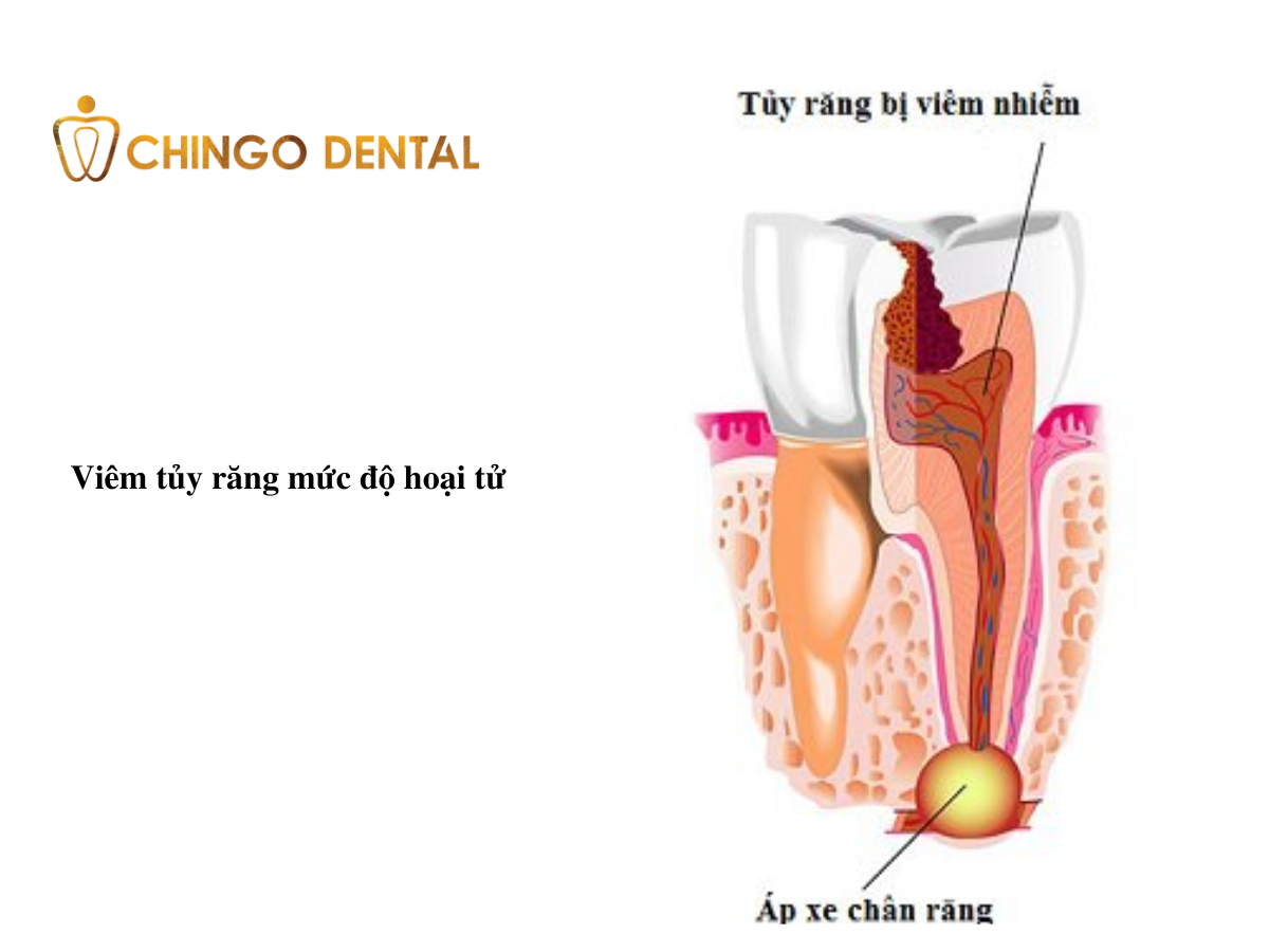 Viem tuy rang la gi Lay tuy rang co dau khong 6