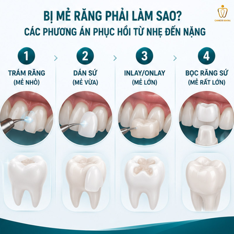 Răng Bị Mẻ: Nguyên Nhân, Nguy Hiểm Và Cách Phục Hồi Hiệu Quả Nhất 4 bị mẻ răng có điềm gì