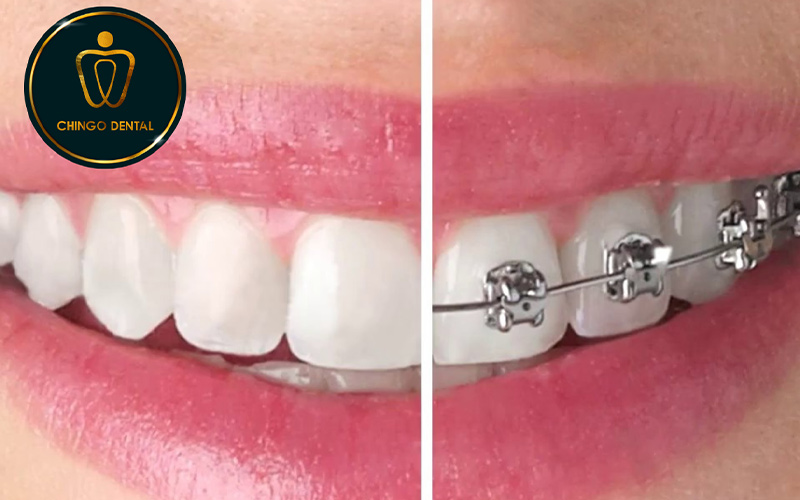 bọc răng sứ có niềng răng được không
