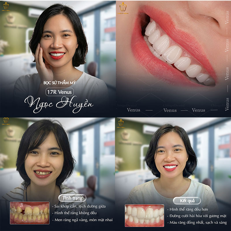 boc rang su xong co nieng duoc khong