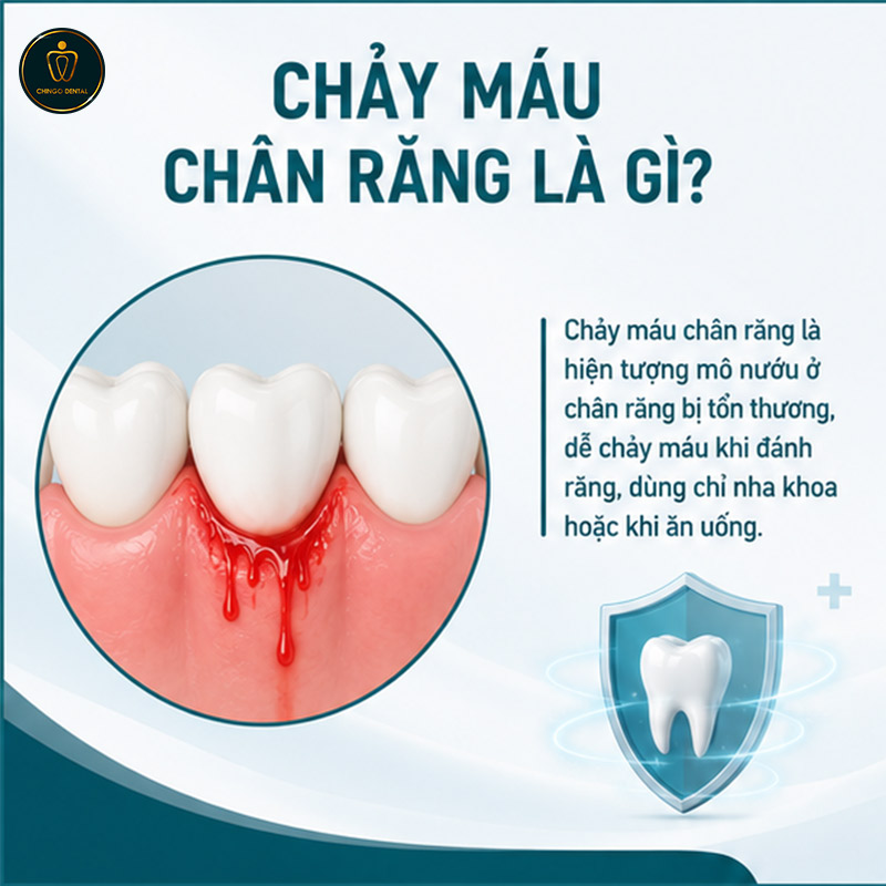Chảy Máu Chân Răng: Nguyên Nhân, Dấu Hiệu Nguy Hiểm Và Khi Nào Cần Gặp Nha Sĩ 1 chảy máu chân răng