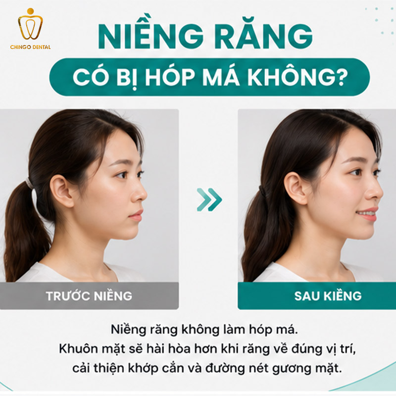 Niềng Răng Có Bị Hóp Má Không? Sự Thật Và Cách Phòng Tránh Hiệu Quả 3 hóp má khi niềng răng
