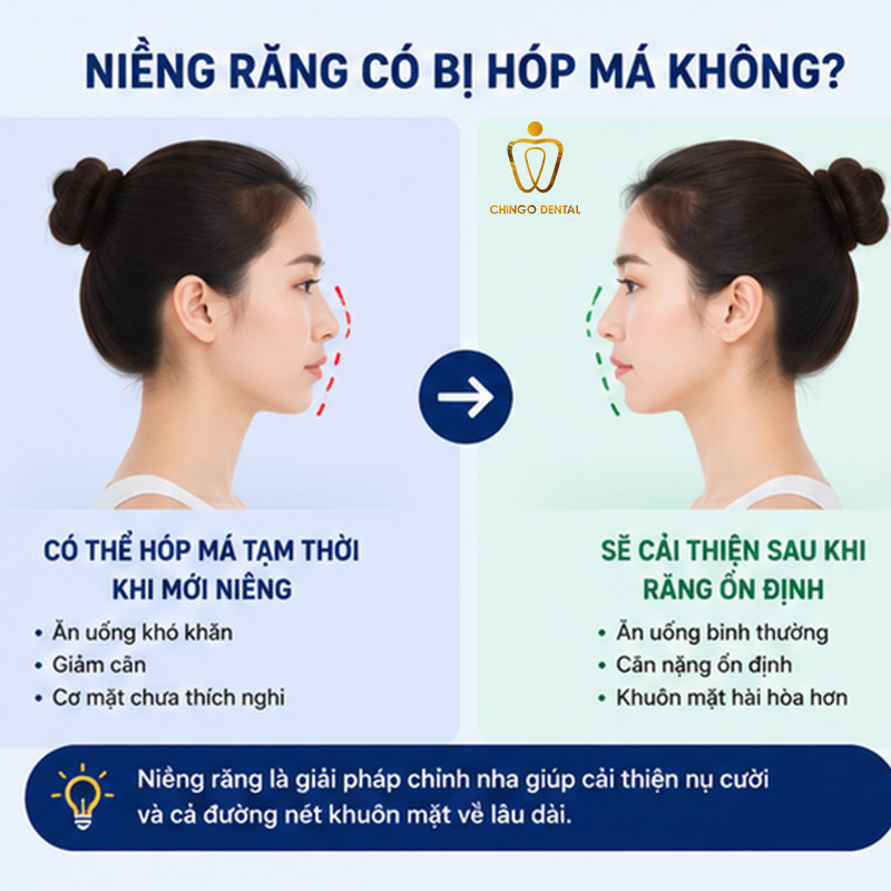 Niềng Răng Có Bị Hóp Má Không? Sự Thật Và Cách Phòng Tránh Hiệu Quả 5 hóp thái dương khi niềng răng