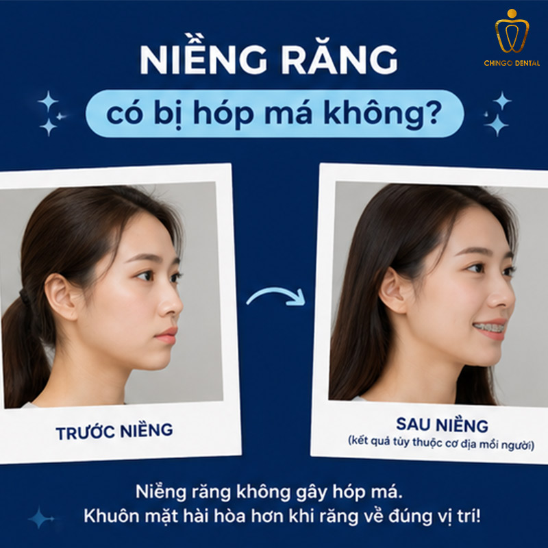 Niềng Răng Có Bị Hóp Má Không? Sự Thật Và Cách Phòng Tránh Hiệu Quả 4 niềng răng bị hóp má