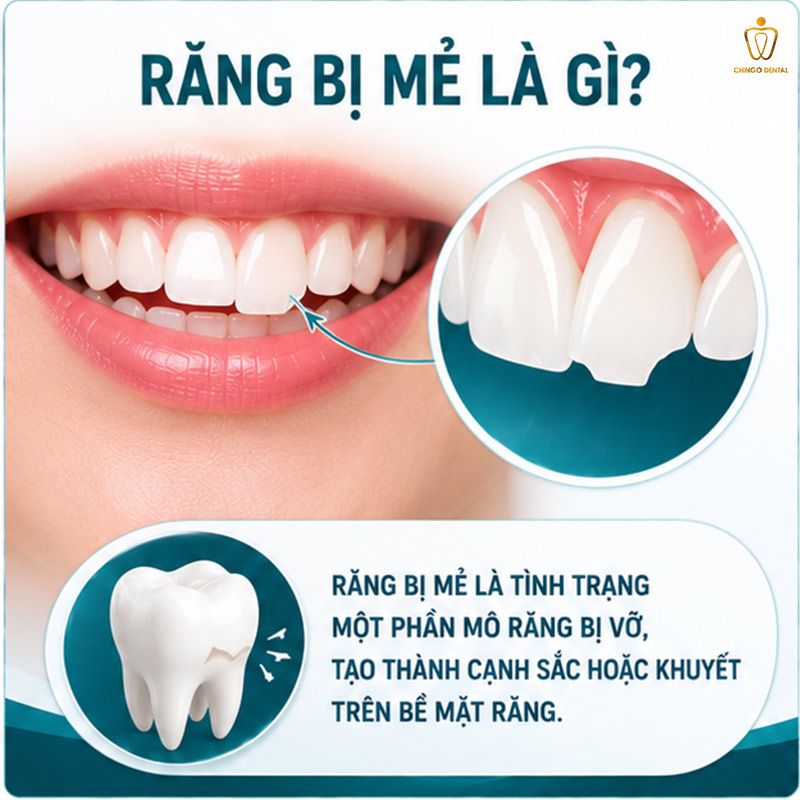 Răng Bị Mẻ: Nguyên Nhân, Nguy Hiểm Và Cách Phục Hồi Hiệu Quả Nhất 1 răng bị mẻ là gì