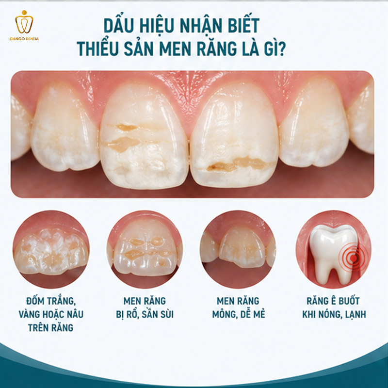 Thiểu Sản Men Răng Là Gì? Nguyên Nhân, Dấu Hiệu Và Cách Phục Hồi Hiệu Quả 3 sinh men bất toàn