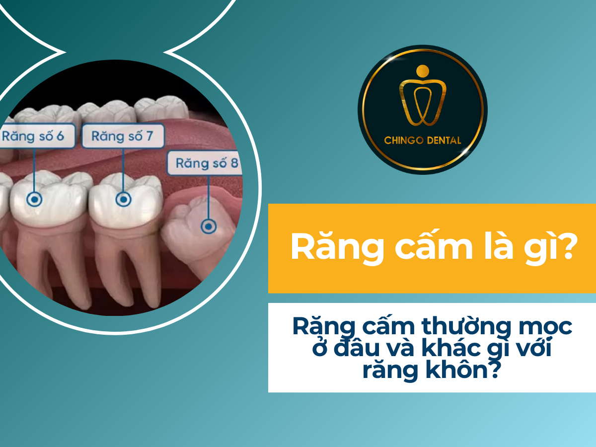 Răng cấm là gì? Răng cấm thường mọc ở đâu và khác gì với răng khôn ...
