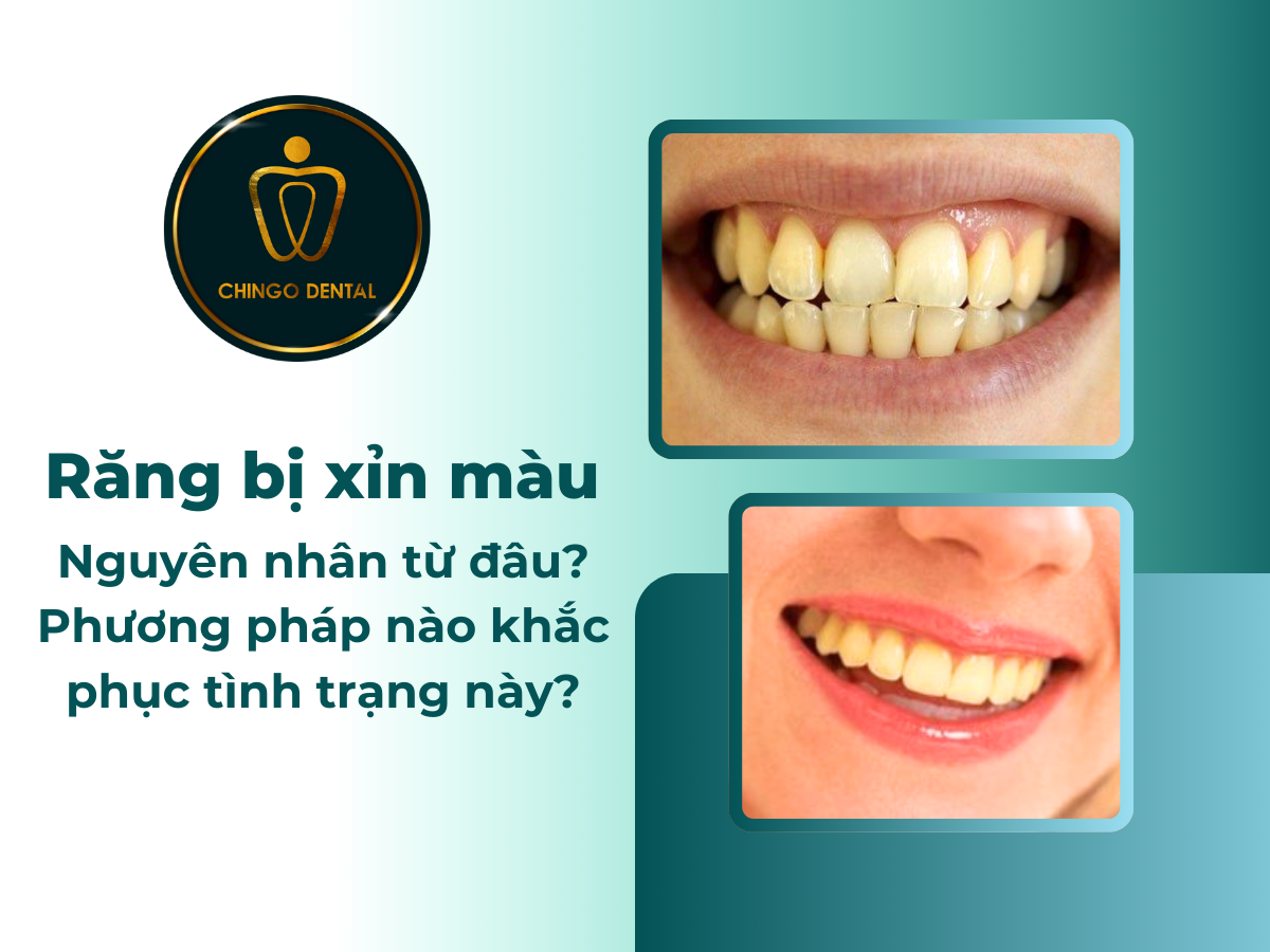 Răng Bị Xỉn Màu: Nguyên Nhân, Mức Độ Và Cách Khắc Phục Hiệu Quả 1