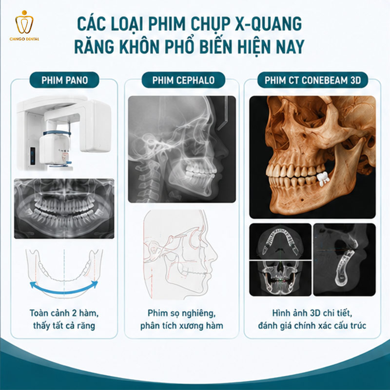 Chụp X-Quang Răng Khôn Bao Nhiêu Tiền? Khi Nào Cần Chụp? 3 chụp x quang răng bao nhiêu tiền