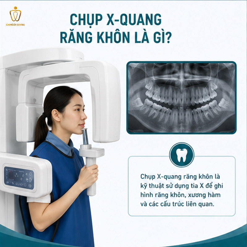 Chụp X-Quang Răng Khôn Bao Nhiêu Tiền? Khi Nào Cần Chụp? 1 chụp x-quang răng khôn