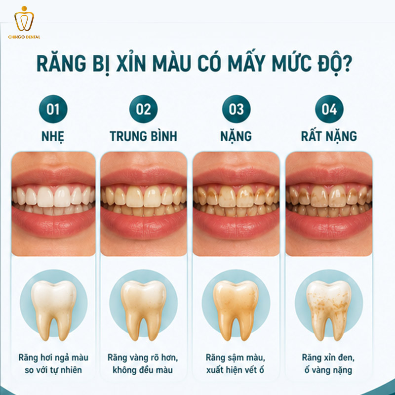 Răng Bị Xỉn Màu: Nguyên Nhân, Mức Độ Và Cách Khắc Phục Hiệu Quả 3 răng bị xỉn màu