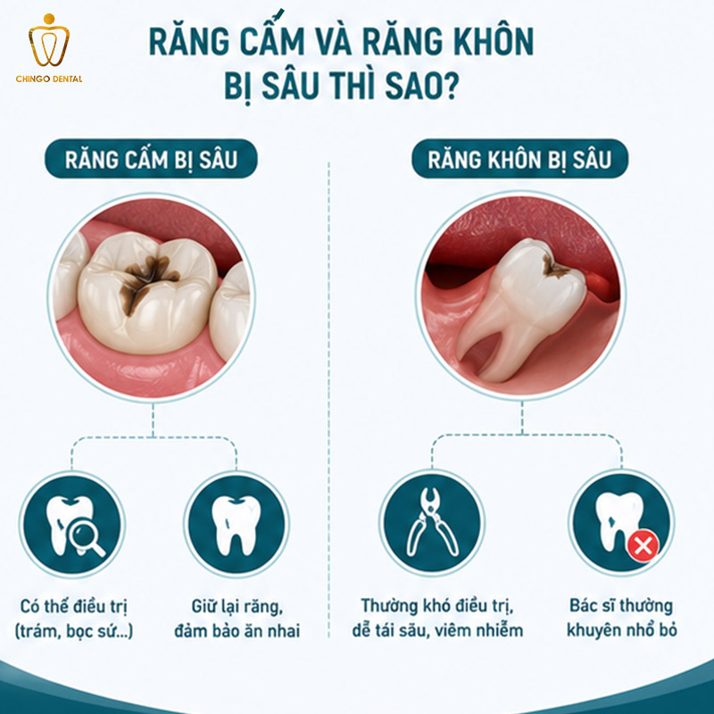 Răng Cấm Là Gì? Phân Biệt Với Răng Khôn, Vị Trí Và Cách Nhận Biết Chính Xác 3 răng khôn