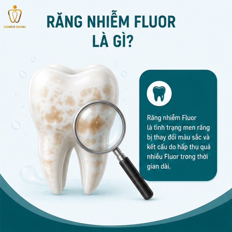 Răng Nhiễm Fluor Là Gì? Nguyên Nhân, Dấu Hiệu Và Cách Khắc Phục Toàn Diện 15 răng nhiễm fluor