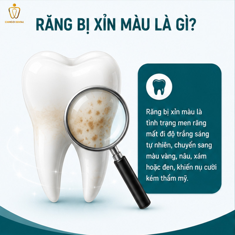 Răng Bị Xỉn Màu: Nguyên Nhân, Mức Độ Và Cách Khắc Phục Hiệu Quả 1 tại sao răng bị xỉn đen