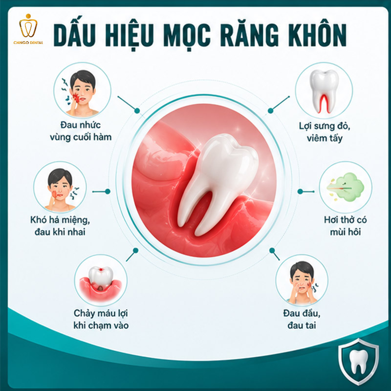 Mấy Tuổi Mọc Răng Khôn? Giải Đáp Chi Tiết Từ Chuyên Gia Nha Khoa 3 bao nhiêu tuổi mọc răng khôn