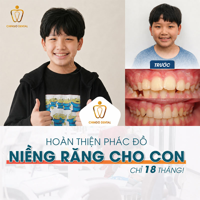 chưa mọc đủ răng vĩnh viễn có niềng được không