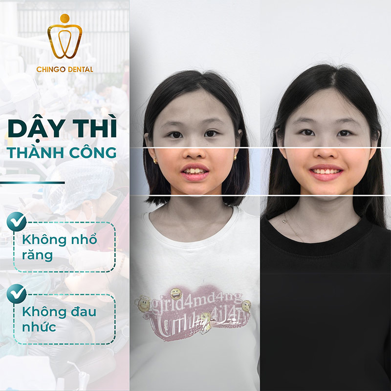 chưa thay hết răng có niềng được không