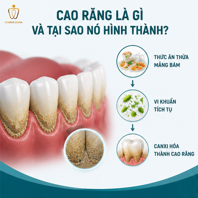 Có Nên Lấy Cao Răng Không? Giải Đáp Toàn Diện Từ Chuyên Gia Nha Khoa 1 có nên lấy cao răng không
