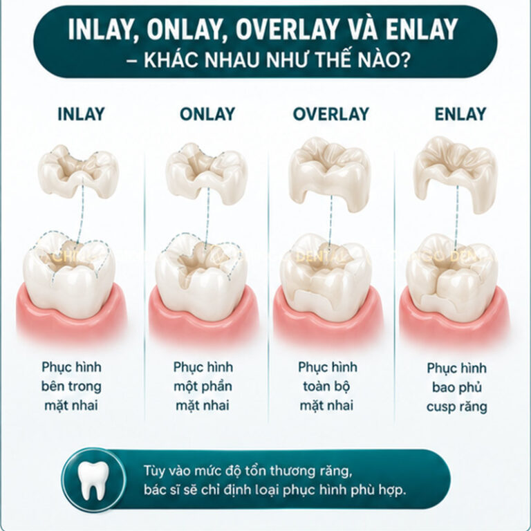Trám Răng Inlay Onlay Là Gì? Giá Bao Nhiêu & Có Thực Sự Bền Hơn Trám ...