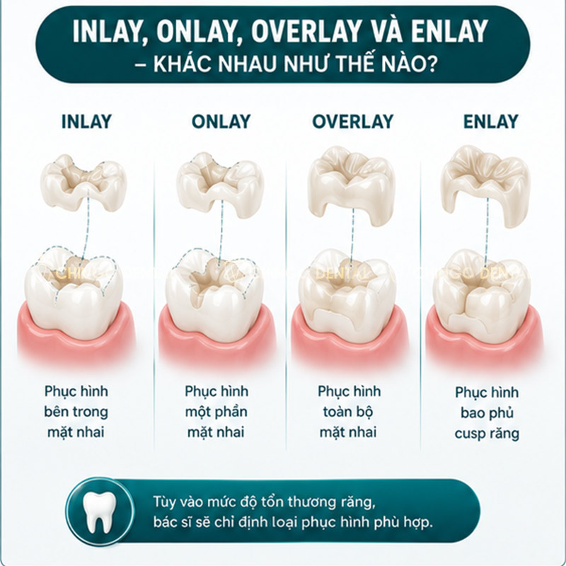 Trám Răng Inlay Onlay Là Gì? Giá Bao Nhiêu & Có Thực Sự Bền Hơn Trám Thường Không? 19 giá trám răng inlay onlay