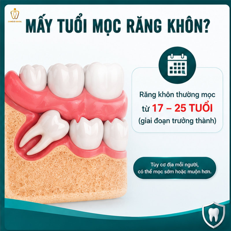 Mấy Tuổi Mọc Răng Khôn? Giải Đáp Chi Tiết Từ Chuyên Gia Nha Khoa 2 răng khôn mọc khi nào