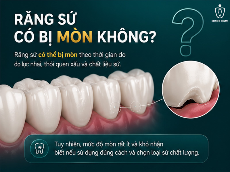 Răng Sứ Có Bị Mòn Không? Sự Thật Và Cách Bảo Vệ Hiệu Quả Lâu Dài 1 răng sứ có bị mòn không