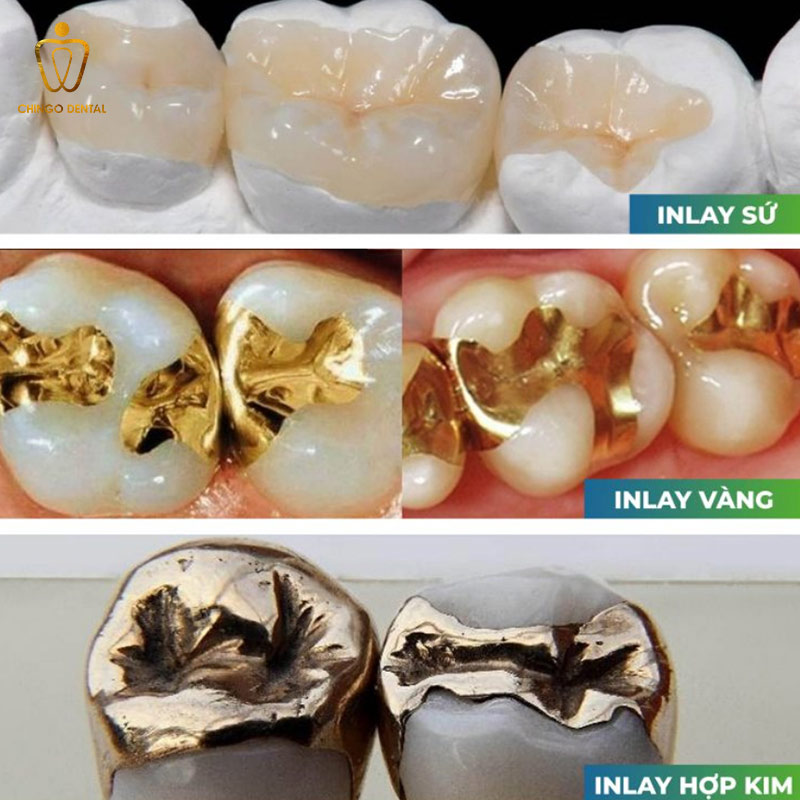 Trám Răng Inlay Onlay Là Gì? Giá Bao Nhiêu & Có Thực Sự Bền Hơn Trám Thường Không? 5 trám răng inlay onlay