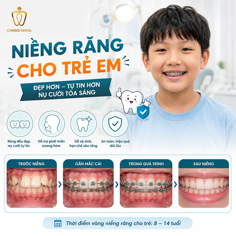 trẻ em đang thay răng có niềng không