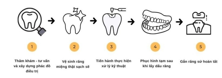 quy-trinh-boc-mao-rang-su-chingo-dental