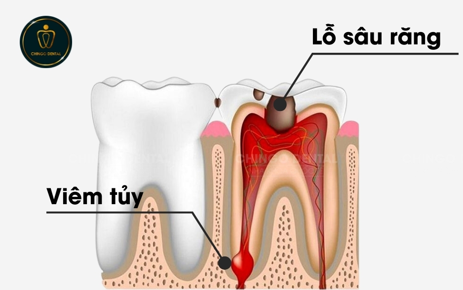 sau-rang-chingo-dental