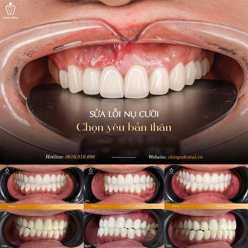 Có Thay Răng Sứ Được Không? Những Ảnh Hưởng Khi Thay Răng Sứ Lỗi 1 Lưu ý quan trọng sau khi thay răng sứ
