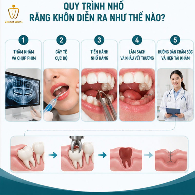 Nhổ Răng Khôn Có Đau Không? Sự Thật Về Mức Độ Đau Và Cách Giảm Đau Hiệu Quả 3 nhổ răng khôn như thế nào