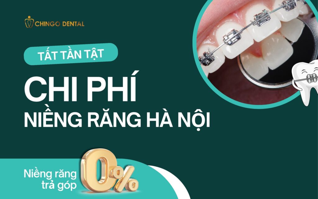 Giá niềng răng hà nội