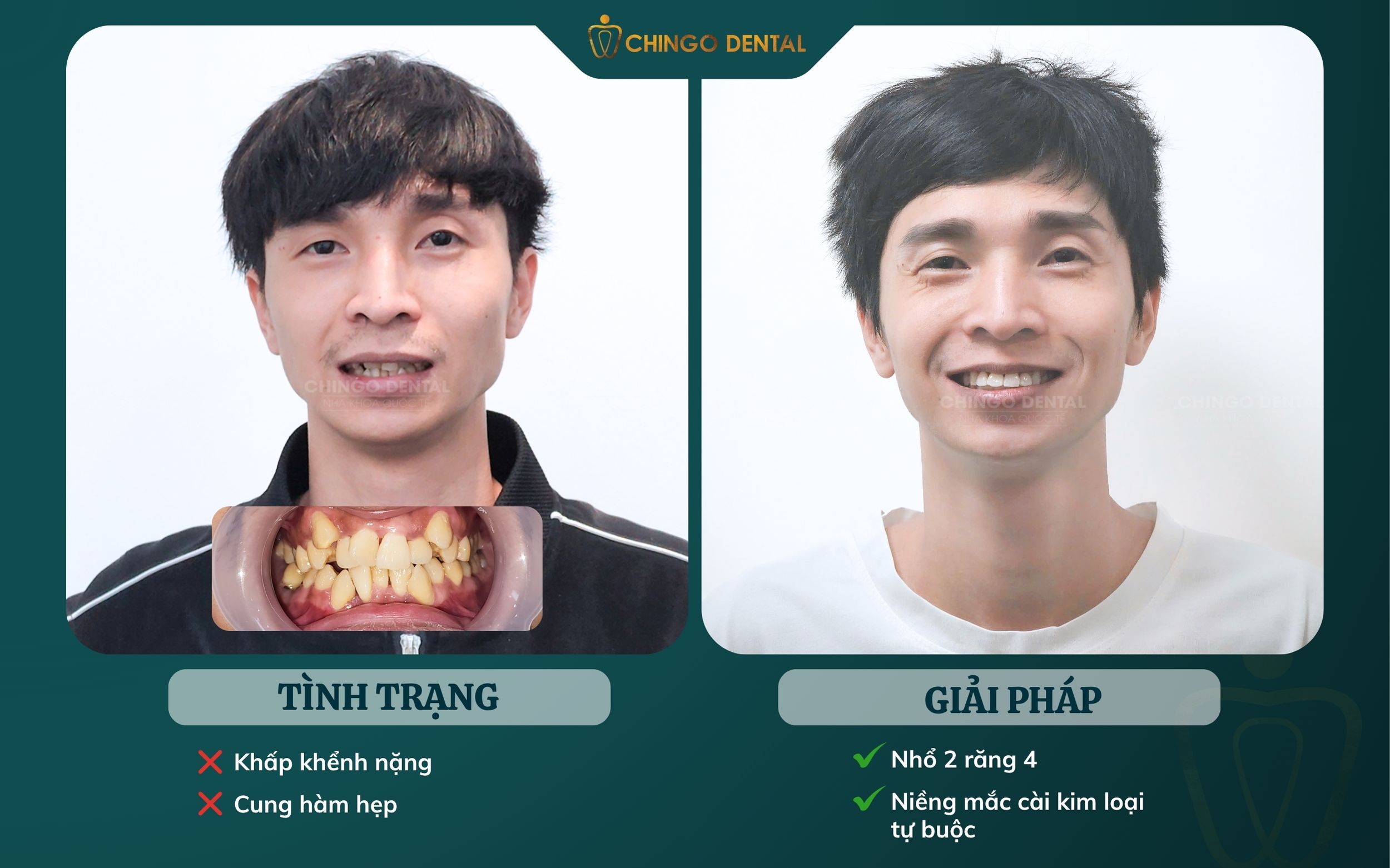 niềng răng hà nội
