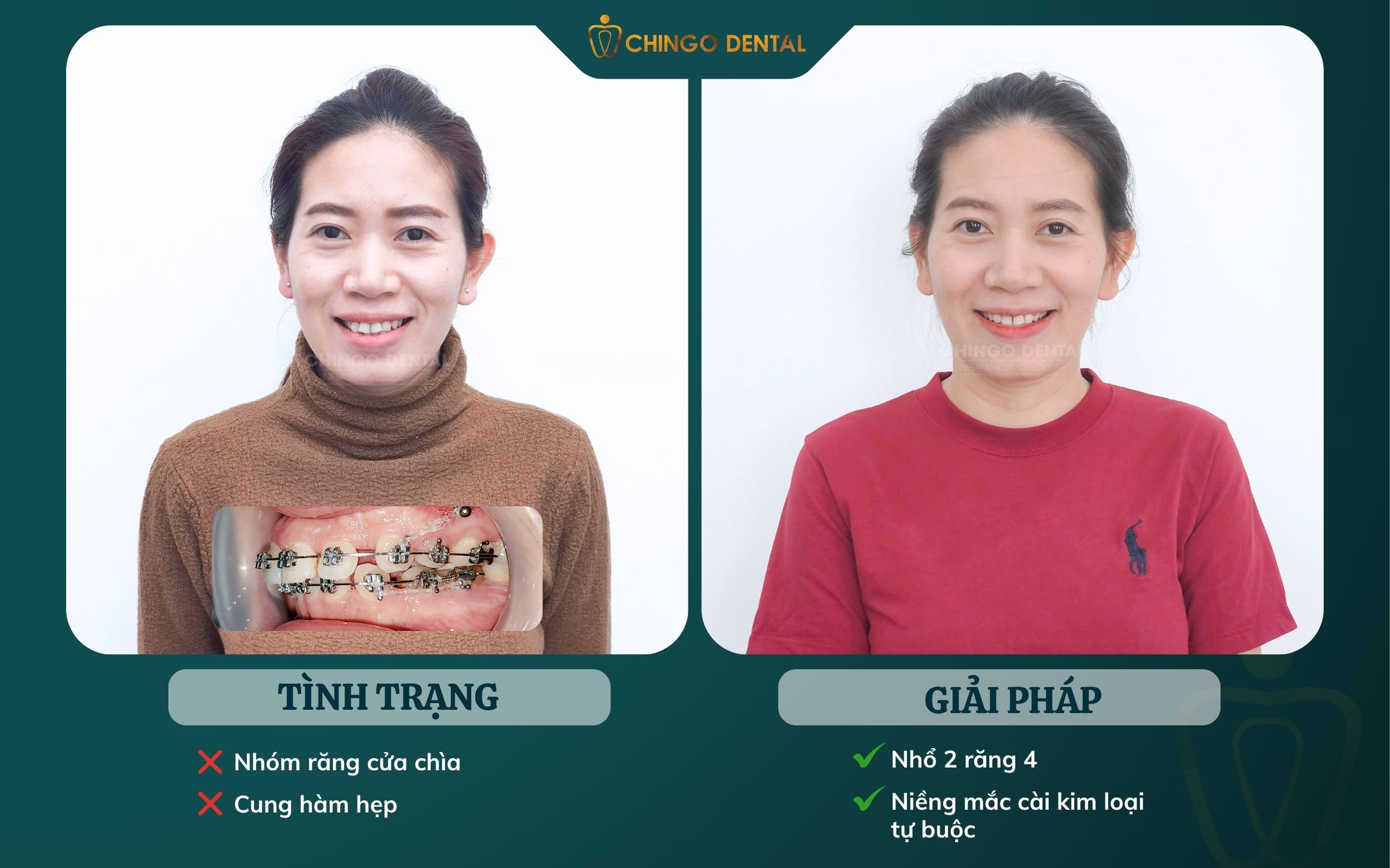 khách hàng niềng răng chingo
